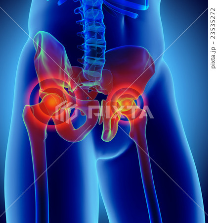 Hip painful skeleton x-ray, 3D illustration. Hip painful skeleton x-ray, 3D illustration. 23535272