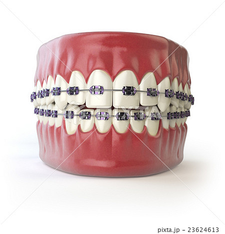 Teeth with braces or brackets isolated on white 23624613