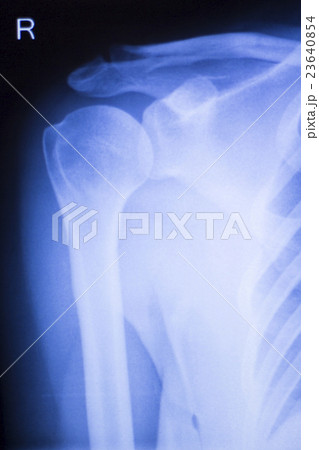 Shoulder joint orthopedic xray scan Shoulder joint orthopedic xray scan 23640854