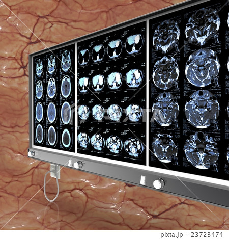 Closeup of a CT scan with brain 3d illustration Closeup of a CT scan with brain 3d illustration 23723474