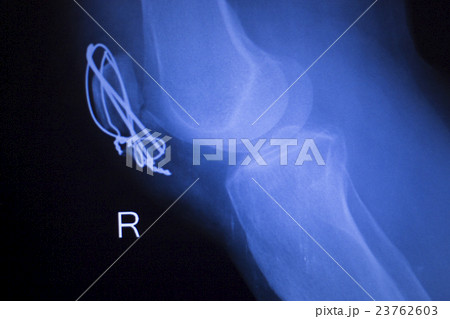 Knee joint orthopedics implant xray 23762603