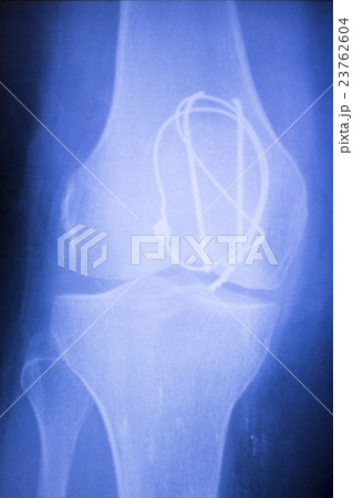 Knee joint orthopedics implant xray 23762604