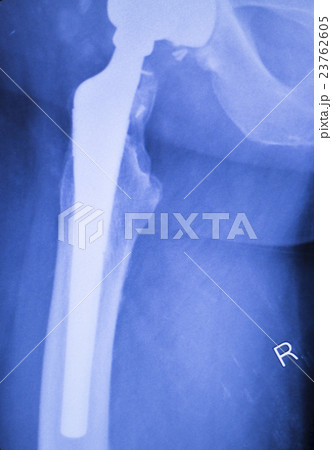 Hip replacement orthopedics implant xray 23762605