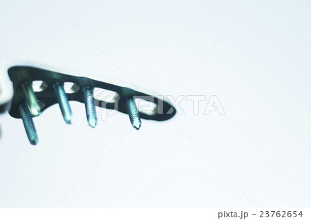 Orthopedic surgery plate & screw implant 23762654