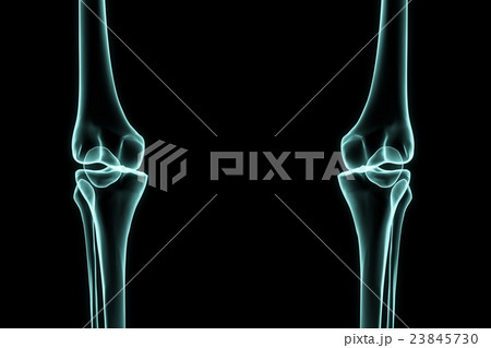 X-ray left and right knee 23845730