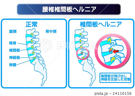 腰椎椎間板ヘルニア 24110156