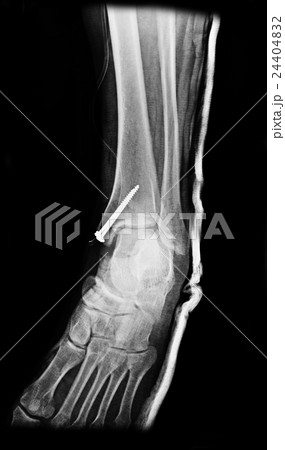 Ankle foot joint orthopedic titanium metal plate Ankle foot joint orthopedic titanium metal plate 24404832