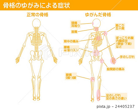 骨格のゆがみのイラスト素材