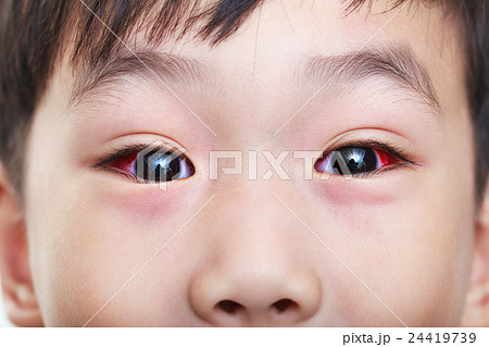 Closeup of chronic conjunctivitis with a red iris. 24419739