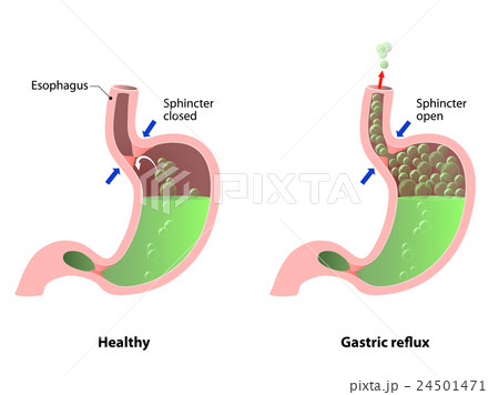 Belching, Heartburn or reflux Belching, Heartburn or reflux 24501471