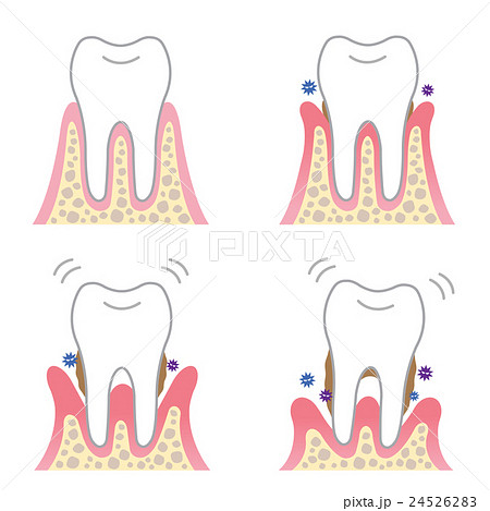 歯周病のイラスト素材