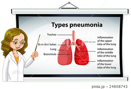 Doctor explaining types of pneumonia Doctor explaining types of pneumonia 24608743