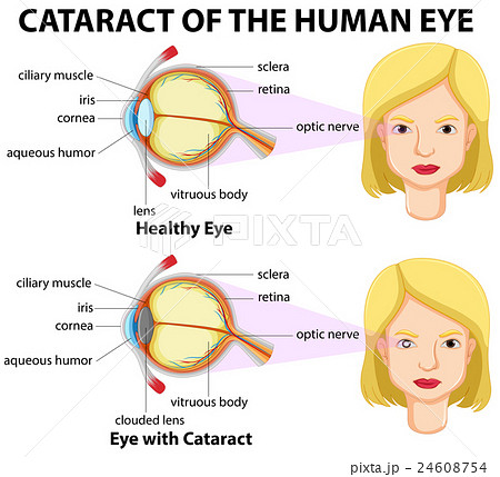 Diagram showing eyes with cataract 24608754