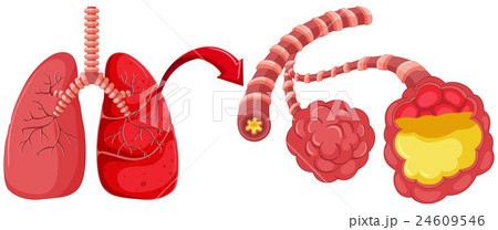 Human lung with pneumonia 24609546