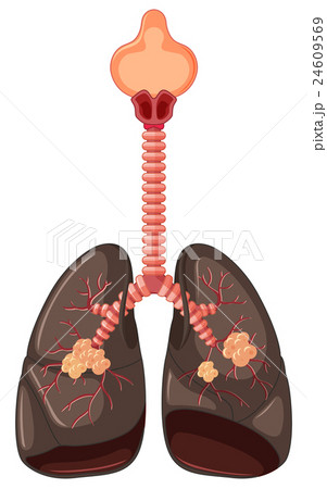 Diagram Of Lung Cancerのイラスト素材