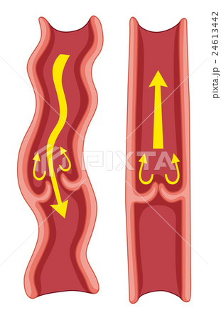 Varicose veins in human body 24613442