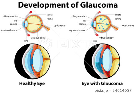 Diagram showing development of glaucoma Diagram showing development of glaucoma 24614057