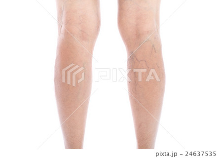 Varicose vein Isolated on white 24637535