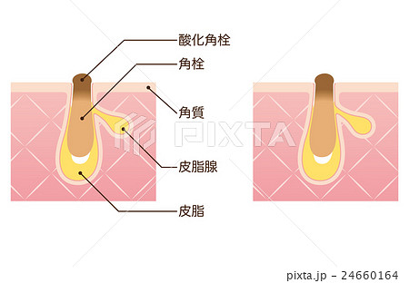 毛穴の構造　角栓　断面図 24660164