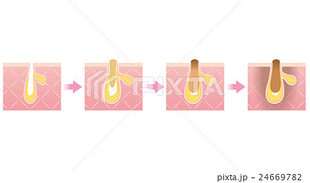 毛穴の構造　角栓　進行図 24669782