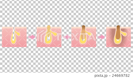 毛穴の構造　角栓　進行図 24669782