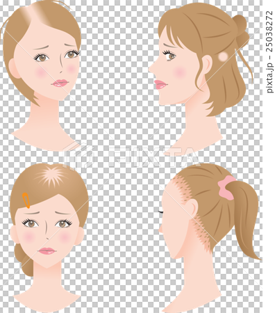 Baldness trouble women 25038272