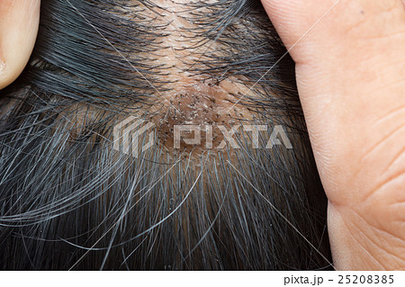 dermatitis in hair or Skin disease on the head 25208385