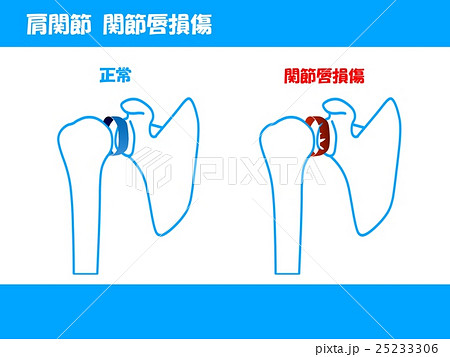 関節唇損傷 25233306