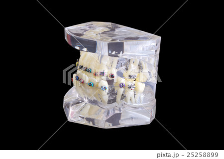 Model of human jaw with wire braces attached Model of human jaw with wire braces attached 25258899