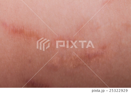 Closeup on stretch marks cellulite on waist belly 25322929