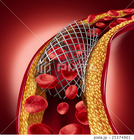 Stent Implant Concept Stent Implant Concept 25374901