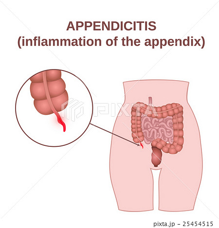 inflammation of the appendix inflammation of the appendix 25454515