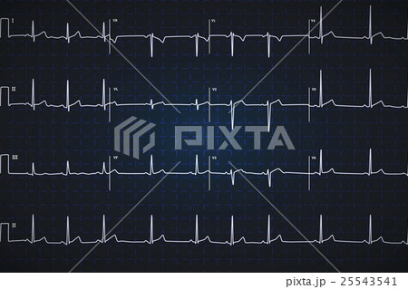 Typical human electrocardiogram 25543541