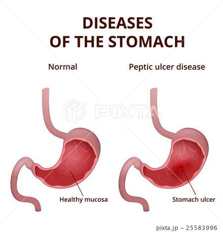 Anatomy of the human healthy and unhealthy stomach Anatomy of the human healthy and unhealthy stomach 25583996