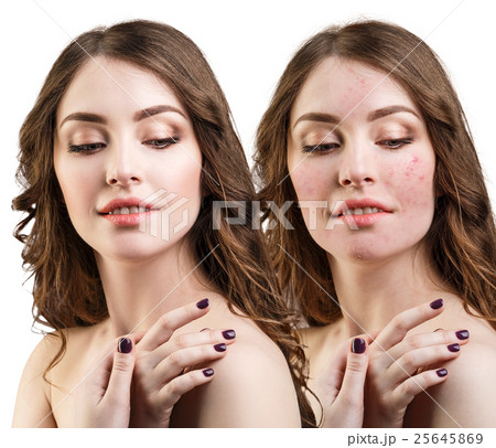 Woman with problem skin on her face Woman with problem skin on her face 25645869