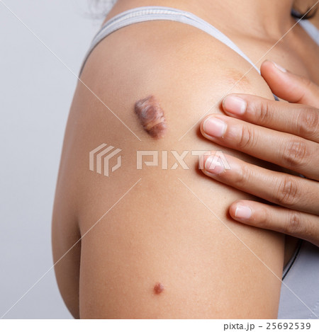 Scar on human skin Scar on human skin 25692539