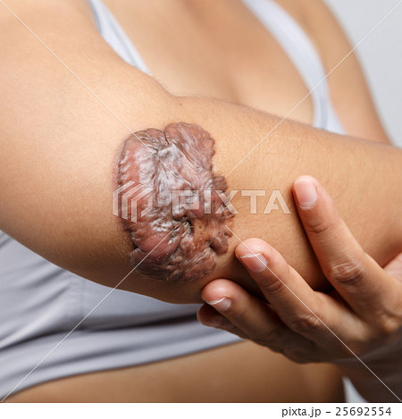 Scar on human skin Scar on human skin 25692554