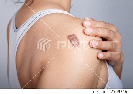 Scar on human skin 25692565