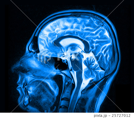 Magnetic resonance imaging of the brain 25727012