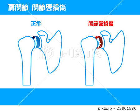 関節唇損傷のイラスト素材