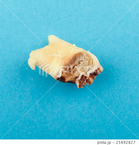 Single highly decayed wisdom tooth 25892827