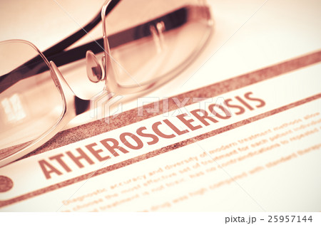 Atherosclerosis. Medicine. 3D Illustration. Atherosclerosis. Medicine. 3D Illustration. 25957144