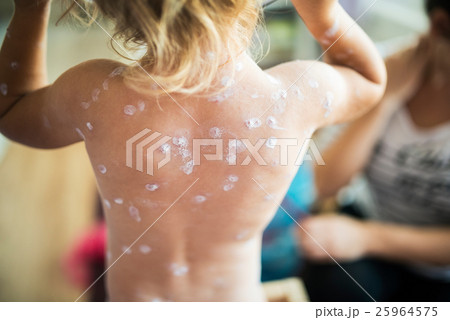 Back of little girl with chickenpox. Rear view. 25964575