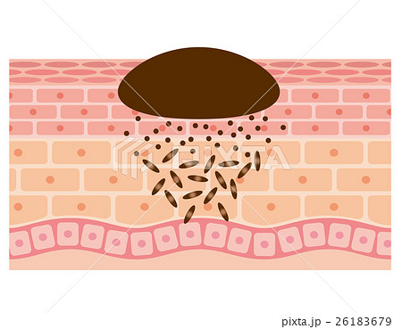 ほくろ 断面図 医療のイラスト素材
