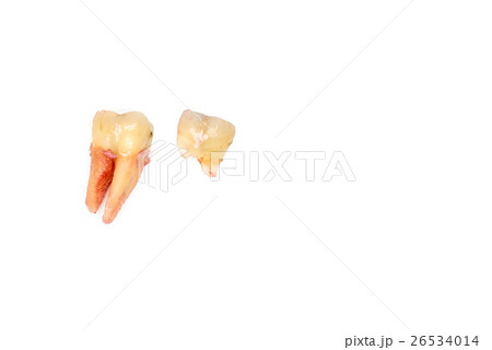 broken tooth removal with dental caries on white 26534014