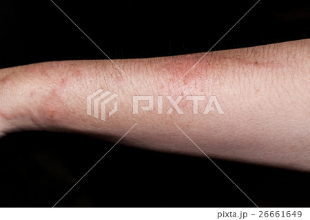 Dog bite wound and scar with dark background 26661649