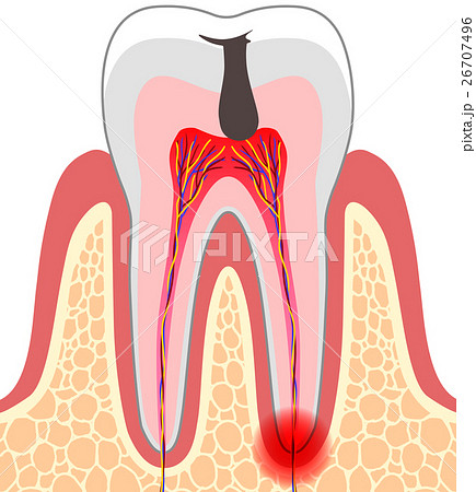 虫歯 断面図のイラスト素材