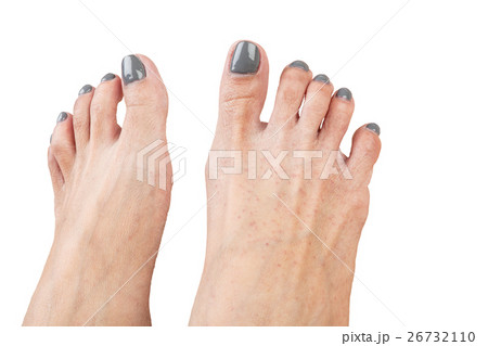 female feet with eczema infect, isolated on white 26732110