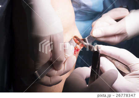 Surgical operation knee surgery Surgical operation knee surgery 26778347