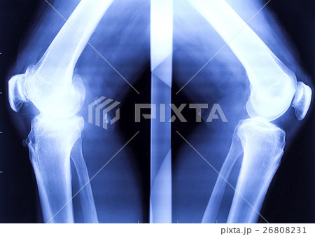 X-ray of the two bended knees X-ray of the two bended knees 26808231
